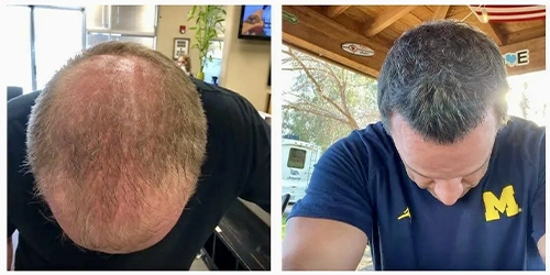 Pain Management Chandler AZ Dan Grant Hair Treatment Before And After